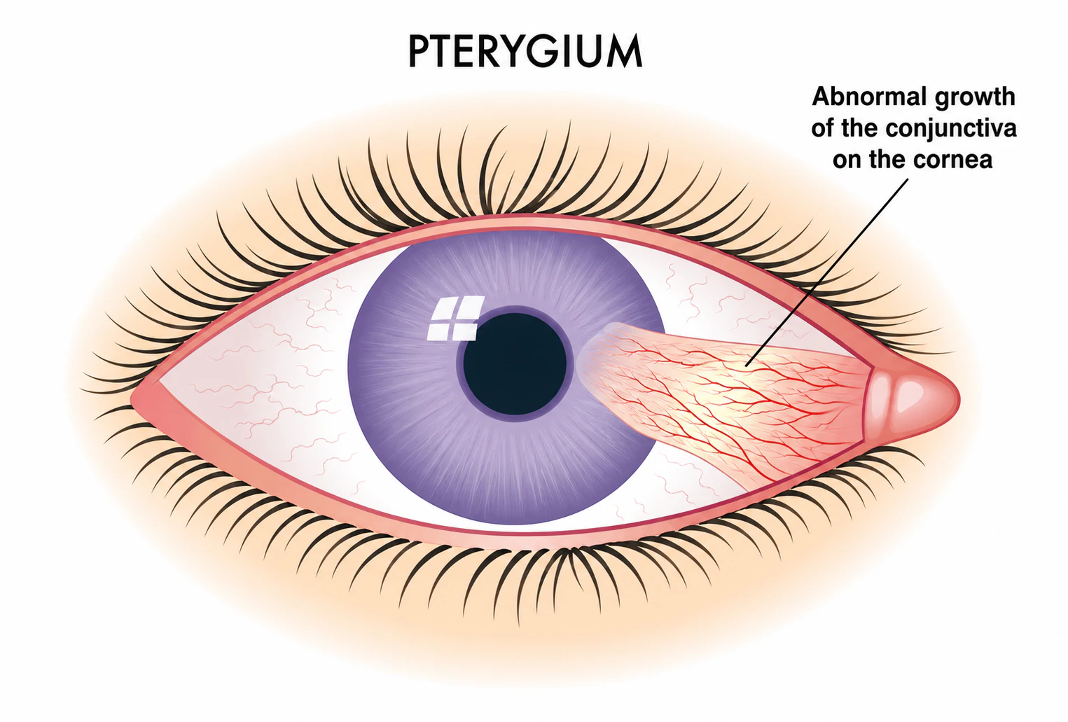 Diagram showing a pink wedge-shaped pterygium growing from the side of the eye onto the cornea