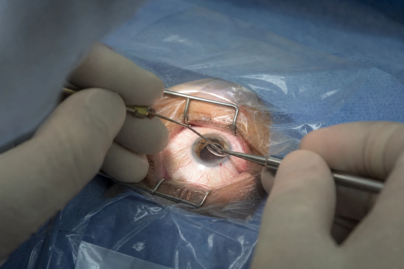 Bimanual Cataract Extraction with IOL Implantation Photo