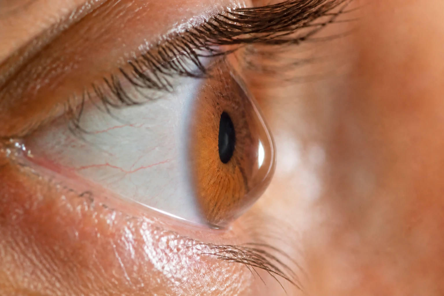 Zoomed in Shot of a Cornea That Needs Corneal Cross Linking Procedure