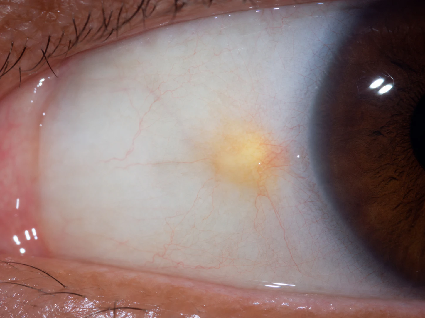 Close-up photograph of a yellowish pinguecula patch on the white of the eye near the nose
