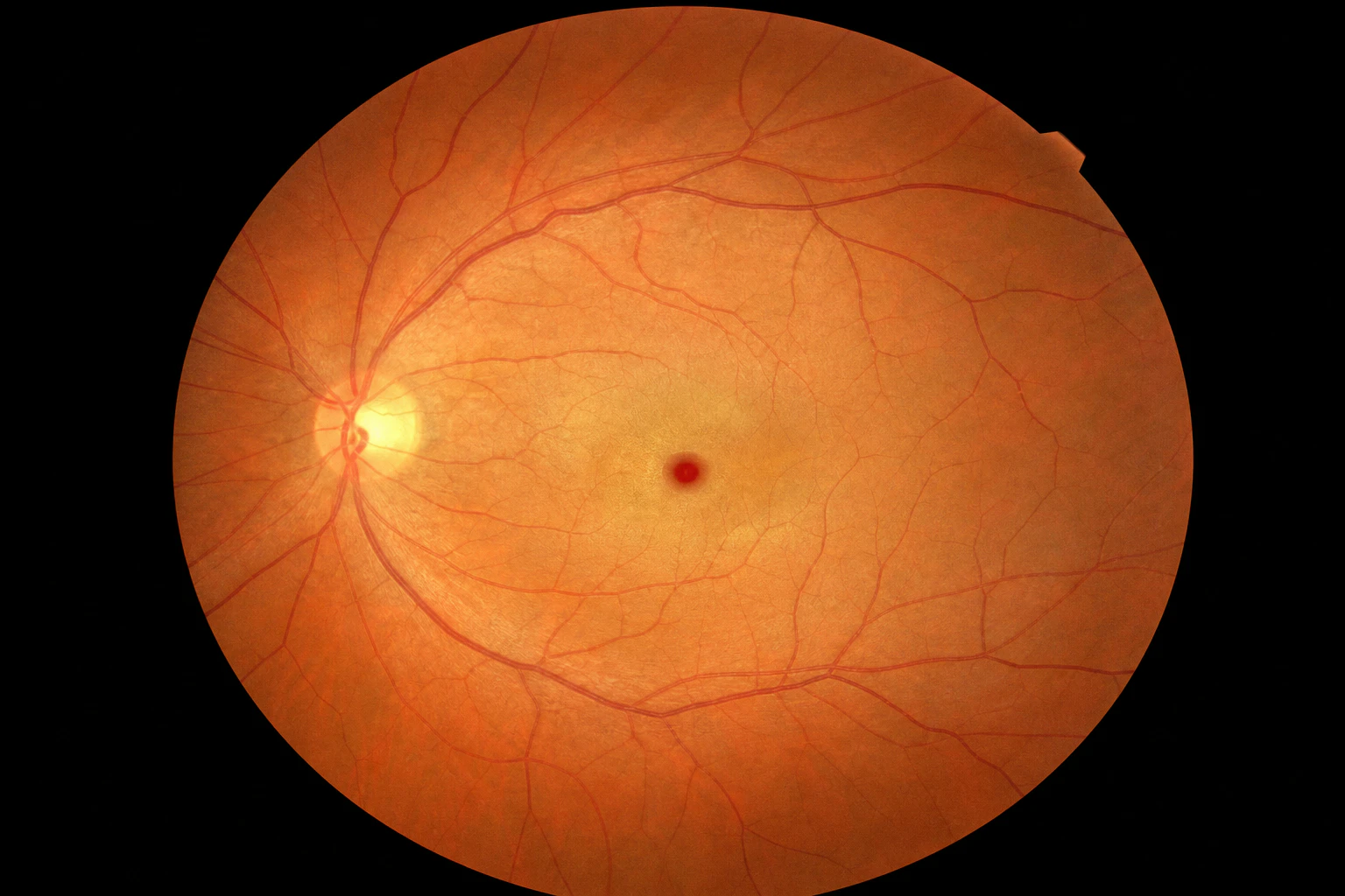 Cherry red spot fundus photo