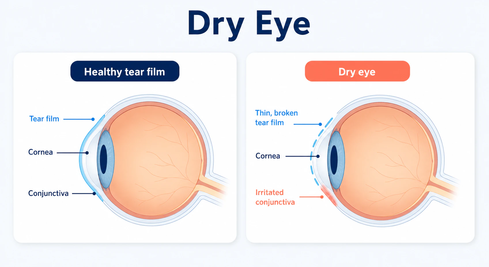 Common causes of dry eye