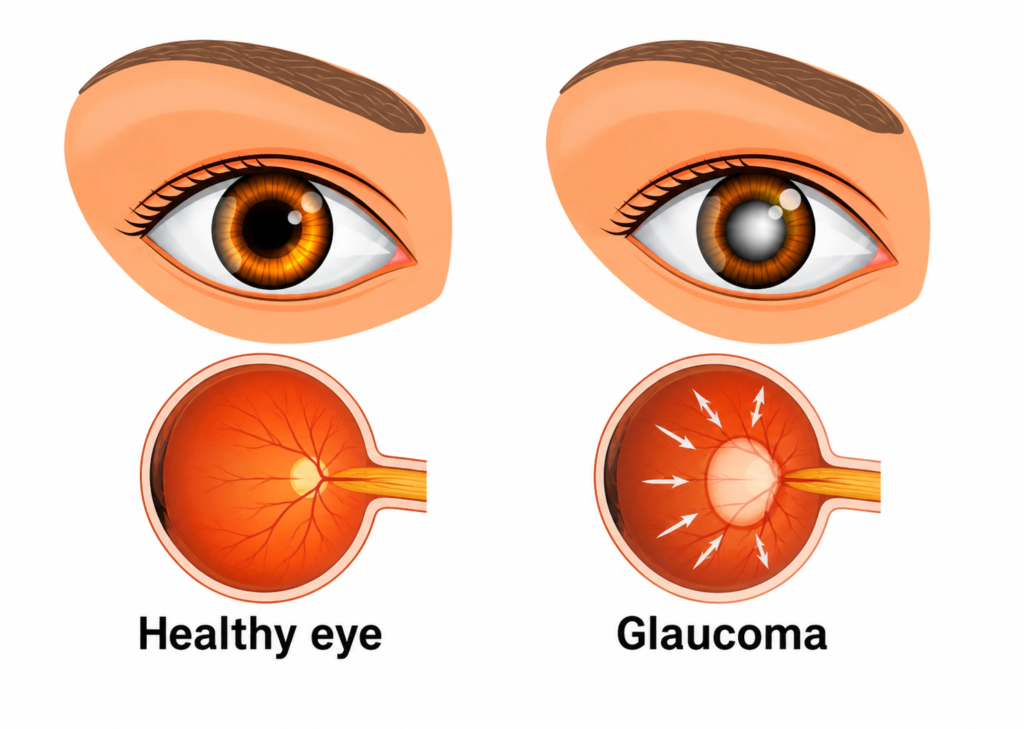 Glaucoma Surgery