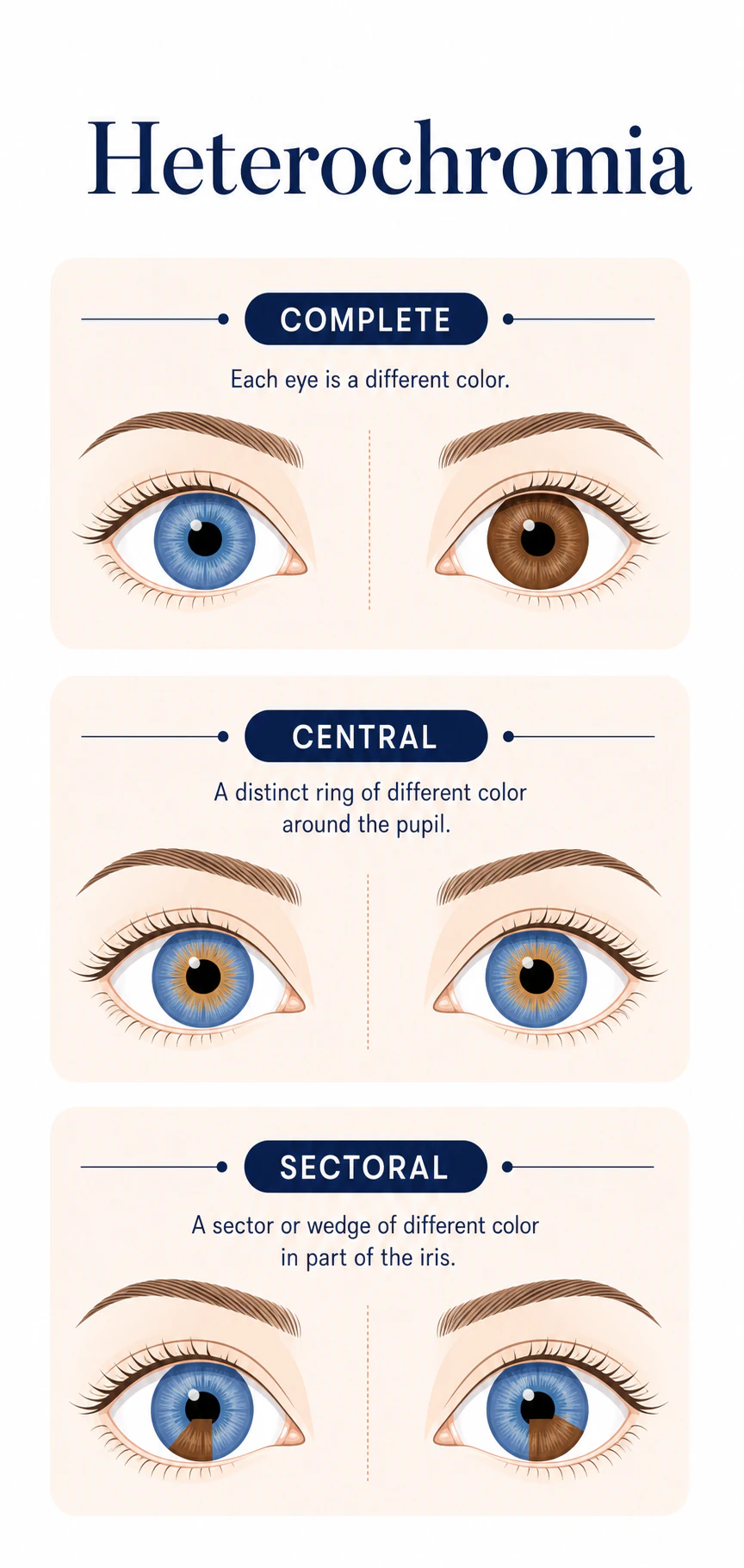 Central heterochromia eye photo