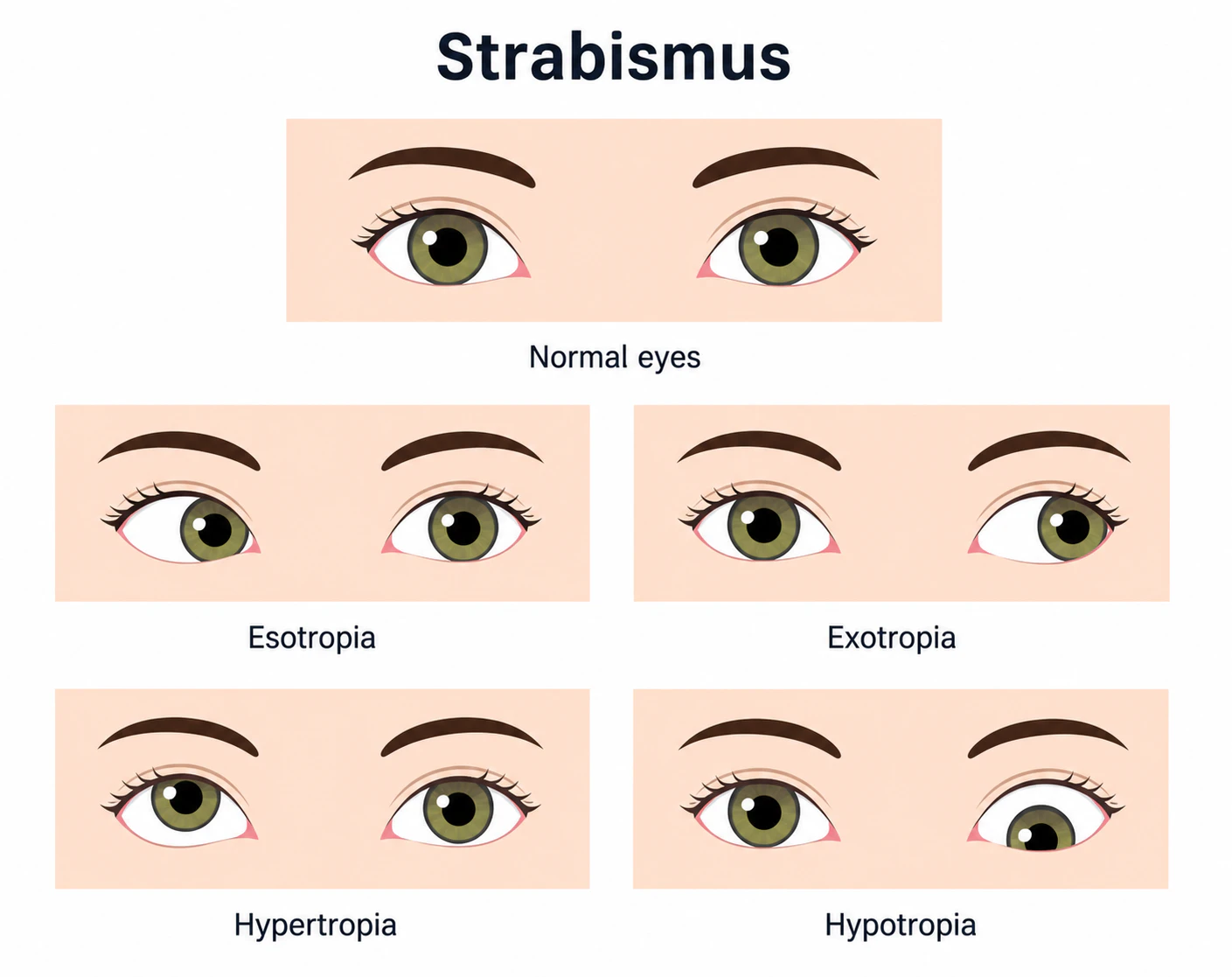 Types of strabismus illustration