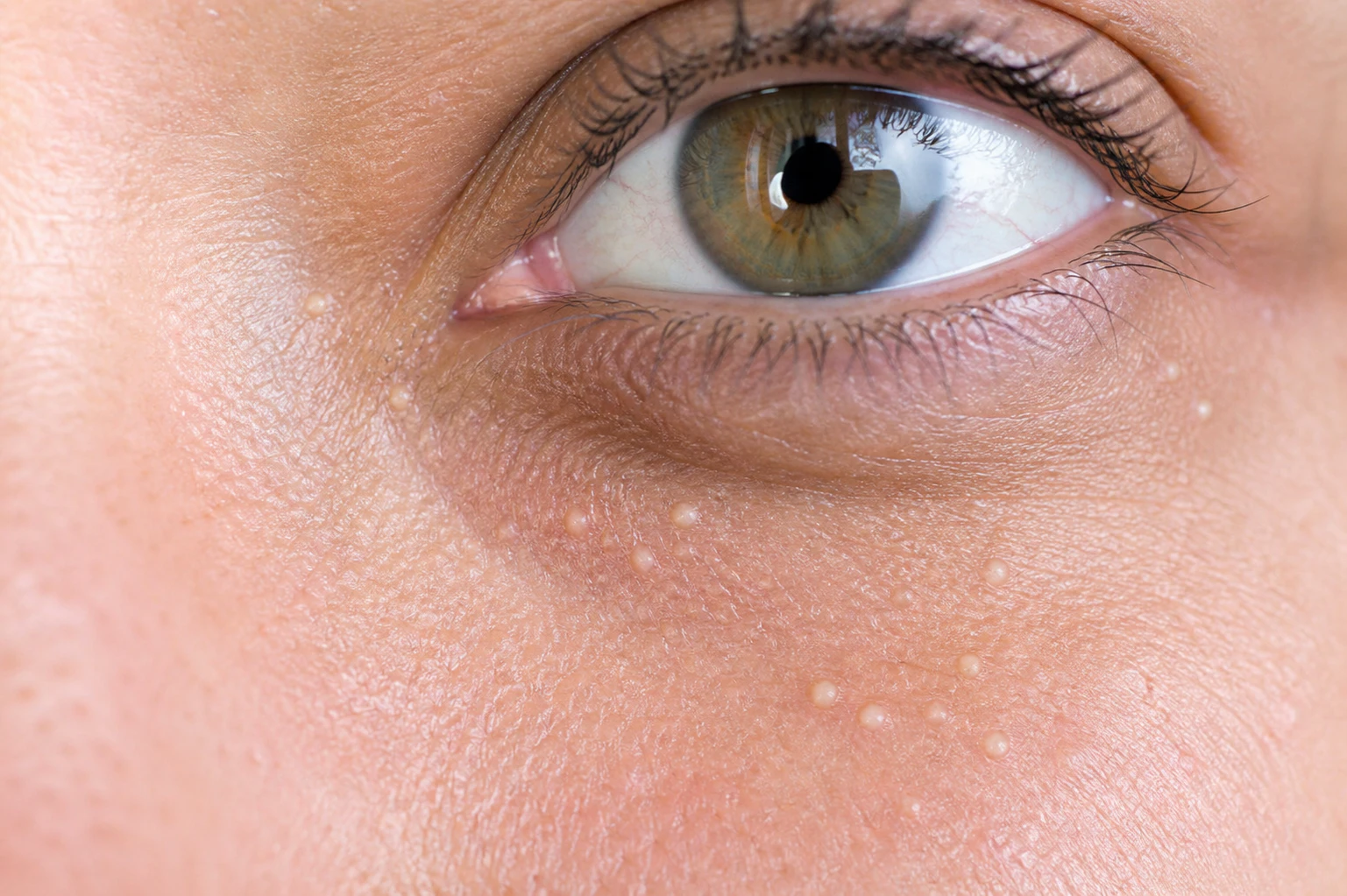 Close up shot of a womans eye with a surrounding milia