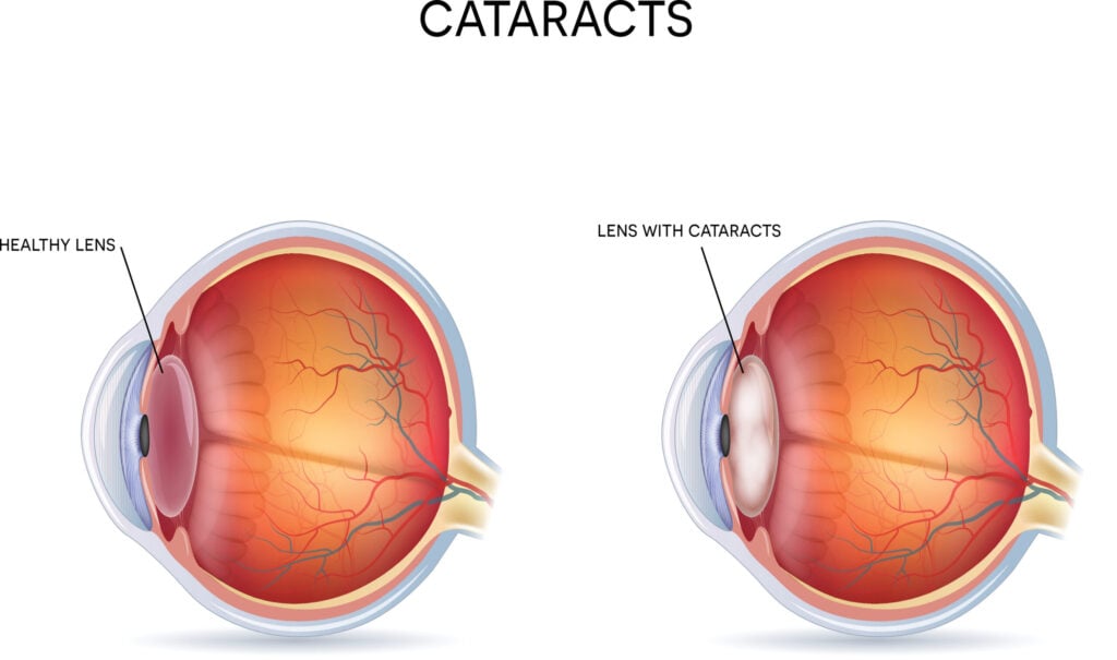Is Cataract Surgery Painful? 4 cataracts scaled e1598035826129