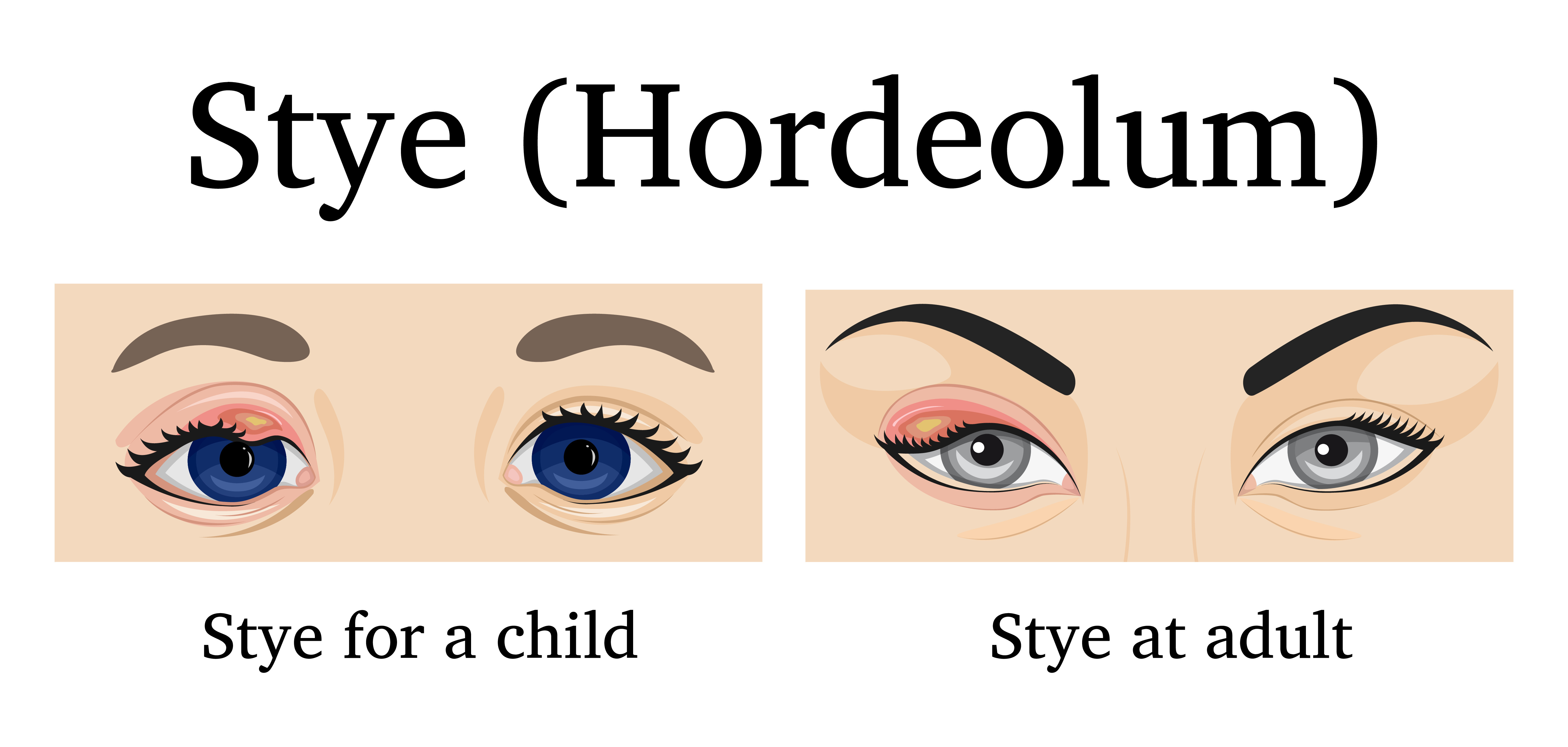 Illustration of Stye