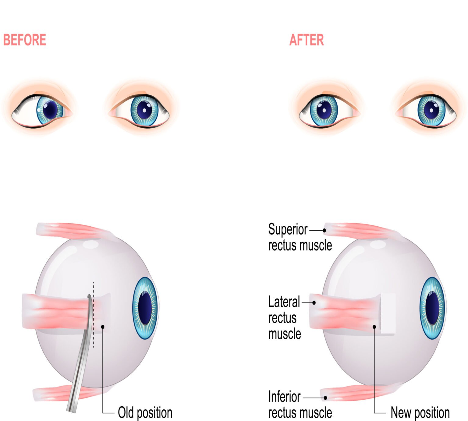 Enucleation — Eye Removal Surgery Explained