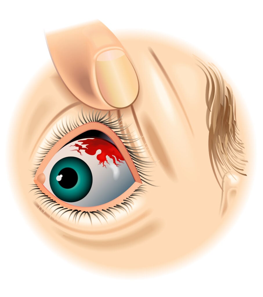 7 of a Red Spot Your Eye (And How to Treat Them)