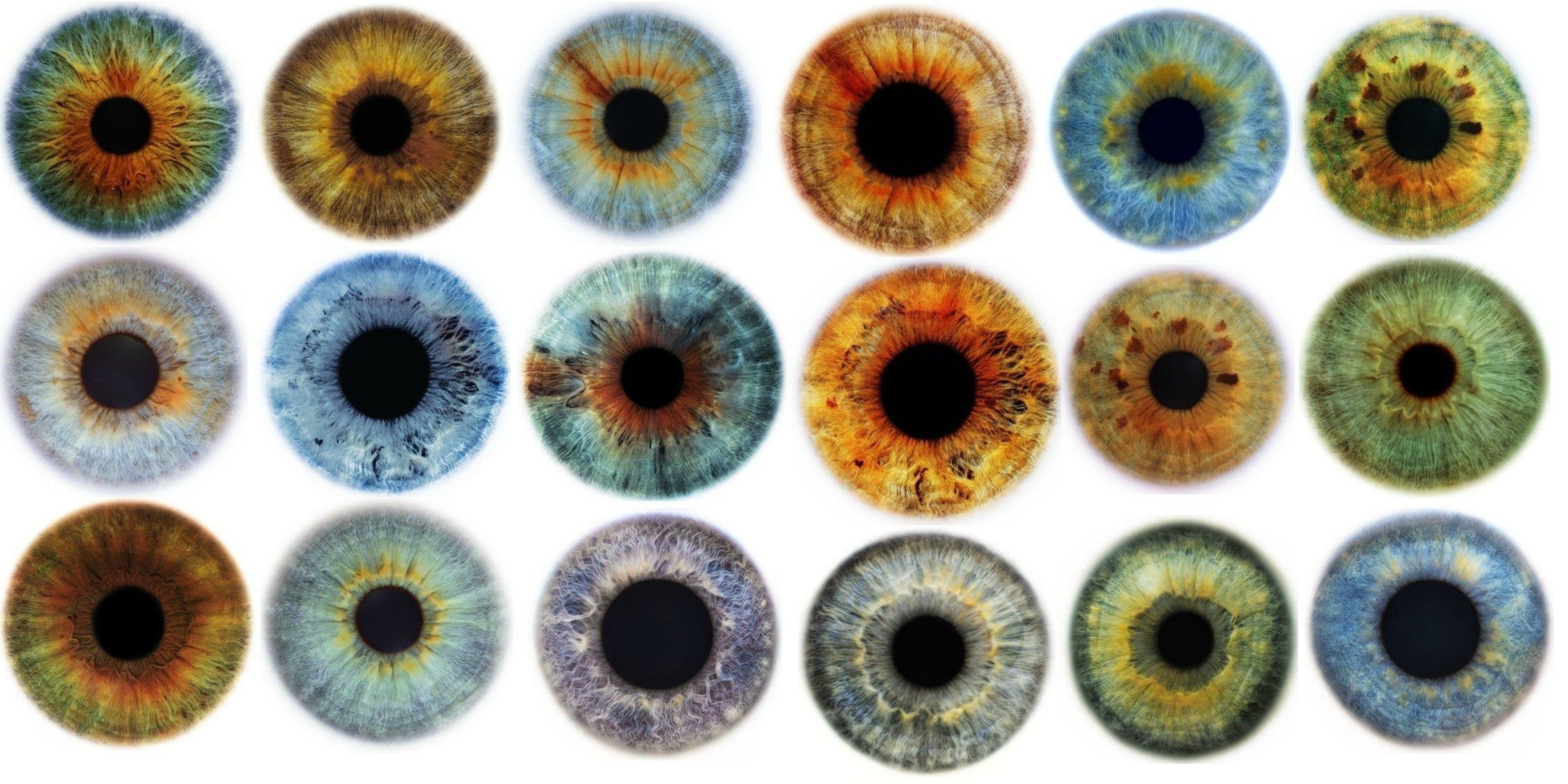 Examples of Central Heterochromia