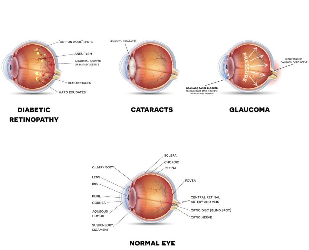 Eye diseases and complications illustration