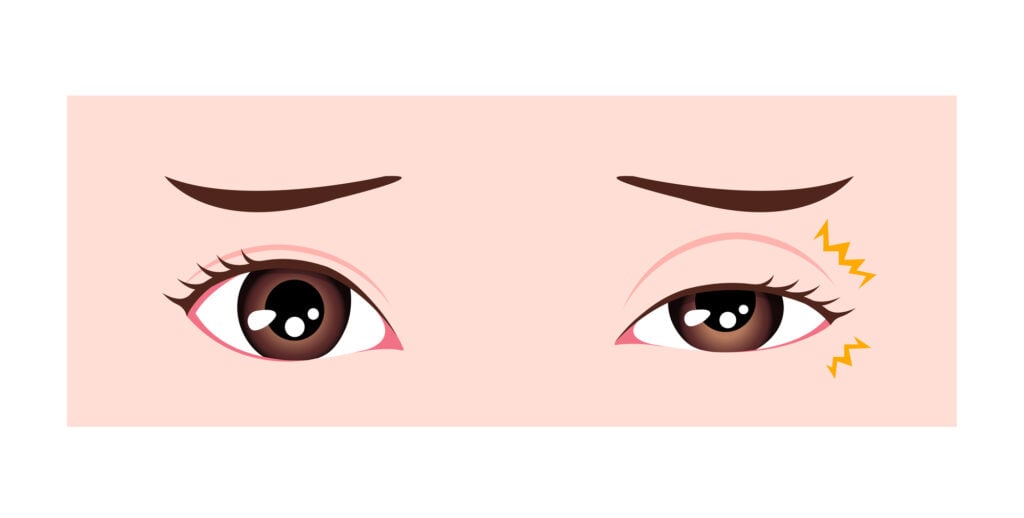 When to See a Doctor for Eye Twitching 2 Illustration of an eye twitching