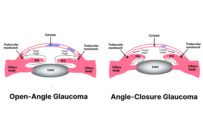What Is Primary Open-Angle Glaucoma? 4 class=