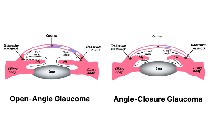 Open Angle and Angle Closure Glaucoma Illustration edited