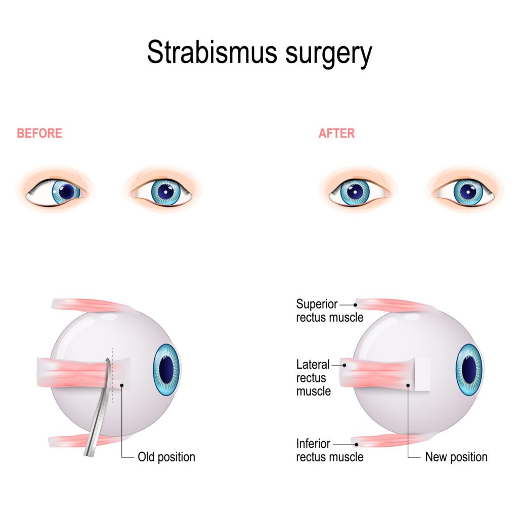 What Causes Strabismus in Children? 4 Strabismus surgery illustration