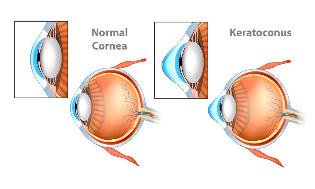 What is Keratoconus?: Symptoms and Surgery Options 4 normal cornea vs Keratoconus eye