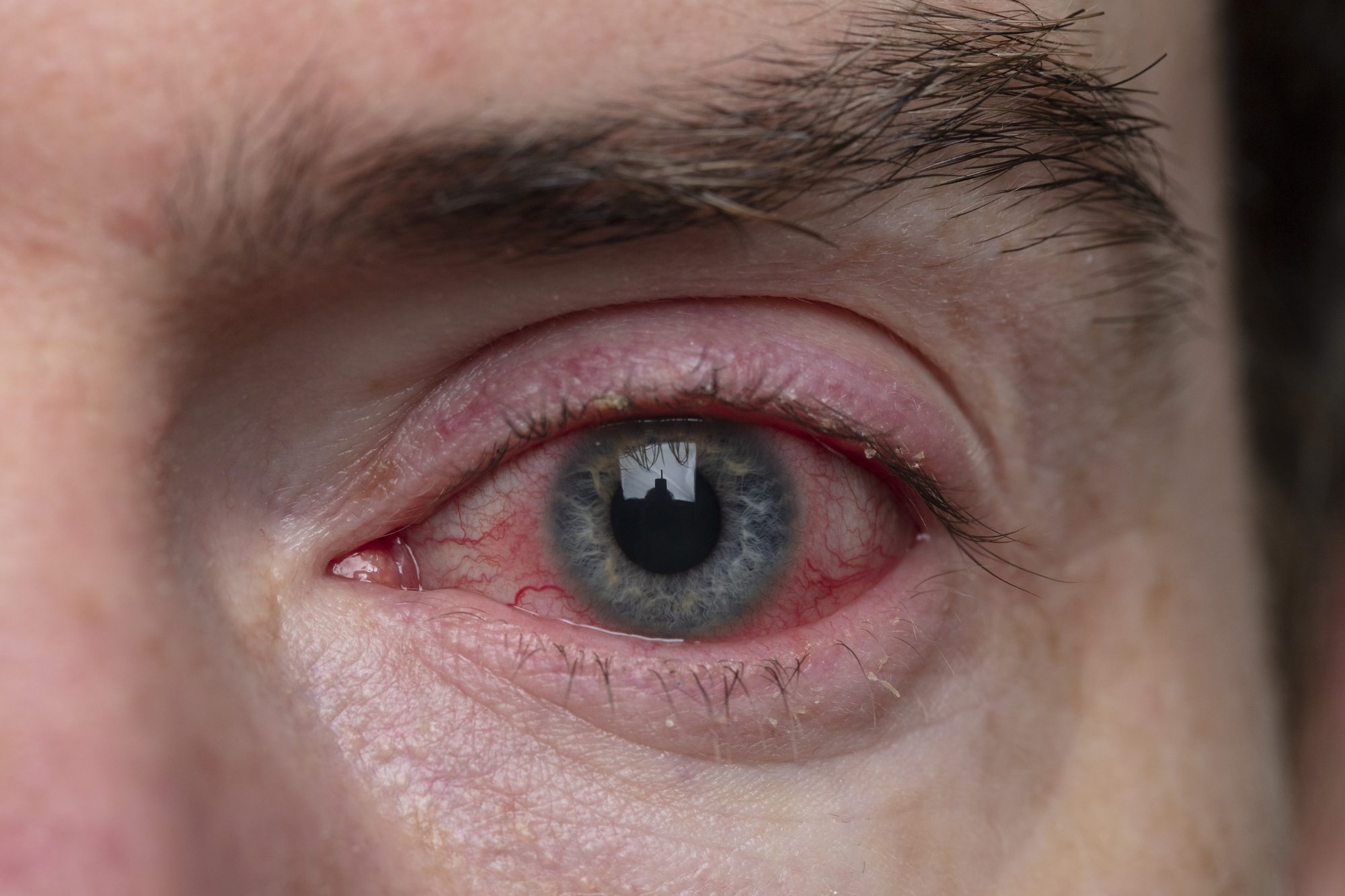 Close-up of a human eye with visible redness and irritation. The iris is blue, and the reflection in the eye shows the silhouette of a castle-like structure. Eyebrows and skin texture are also visible.