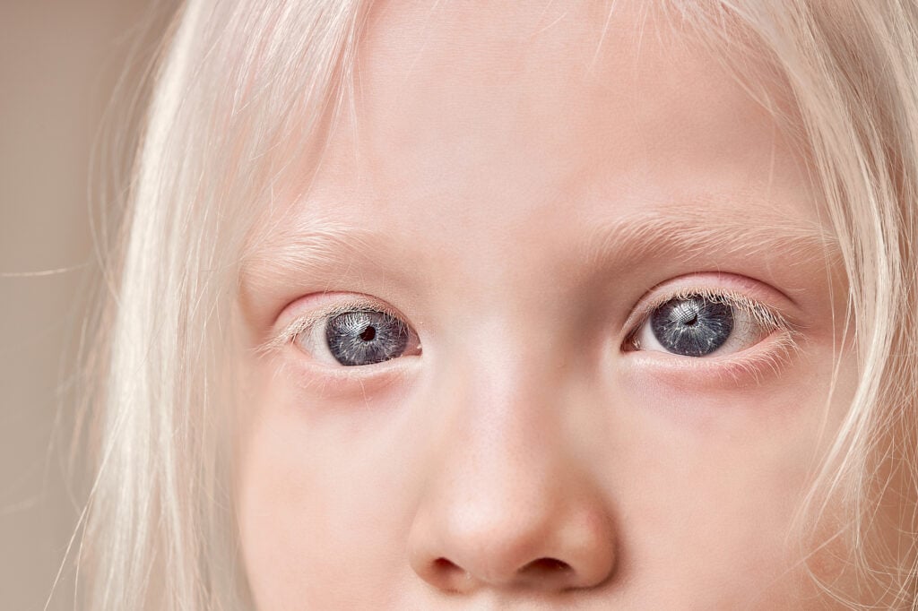 Albino Eye Color Understanding Its Unique Appearance