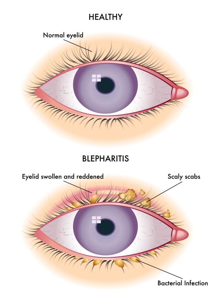 Blepharitis Swollen Eyelids Symptoms Causes Treatment