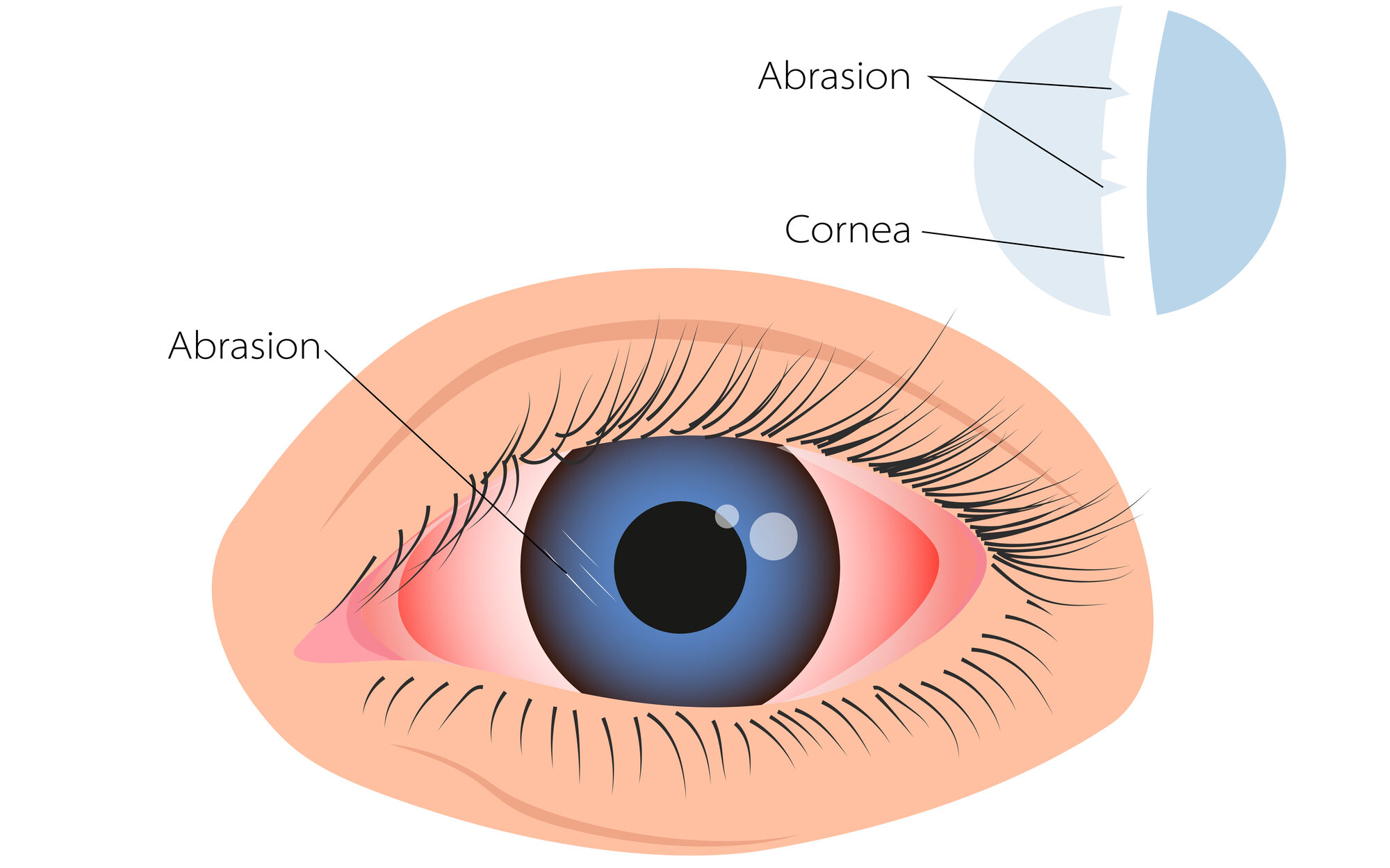 What is Eye Pain? 10 Corneal Abrasion illustration edited
