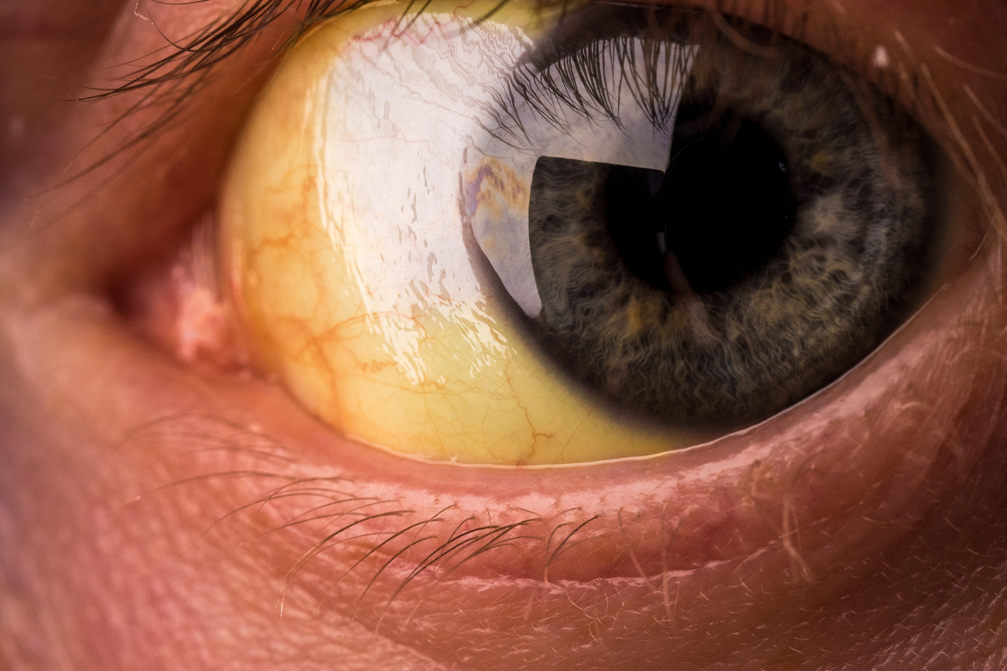 Close-up of a human eye showing the sclera with a yellow tint, indicative of jaundice. The iris is grayish-blue with visible blood vessels, and eyelashes are present at the top of the image.