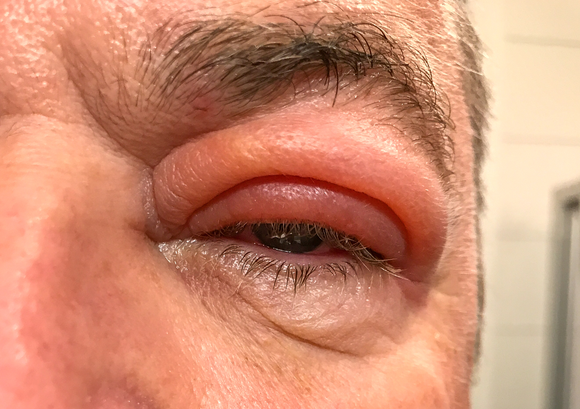 A close-up image of a person's eye with noticeable eyelid swelling and redness. The surrounding skin appears slightly irritated, and some wrinkles are visible around the eye area.