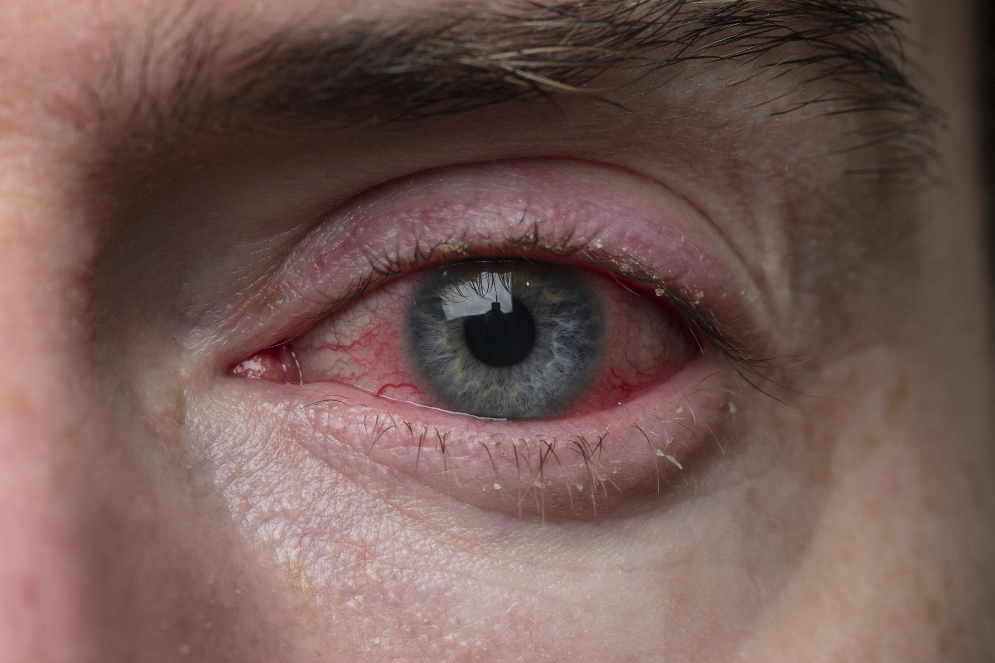 Close-up of a human eye with a blue iris, red veins on the white sclera, and a slightly swollen eyelid. The skin around the eye appears textured, and some light reflections are visible on the eye's surface.