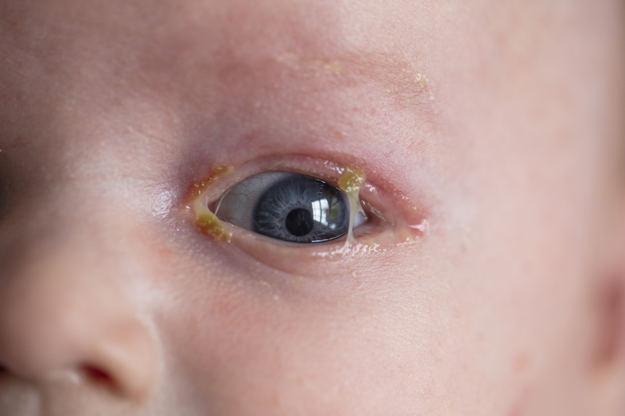 Close-up of an infant's eye with visible yellow discharge around the eyelids and tear duct, indicating possible eye infection or irritation. The baby's blue eye shows reflection from a window in the pupil. The skin appears slightly textured.