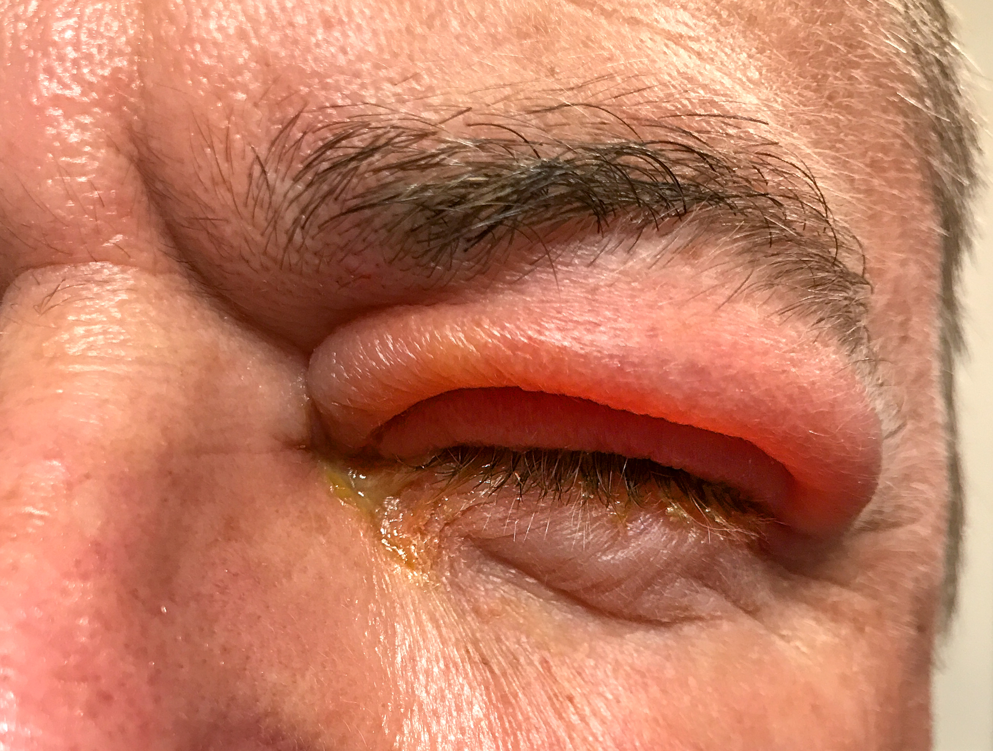 A close-up of a partially closed, swollen human eye with red, inflamed eyelid and visible irritation. .