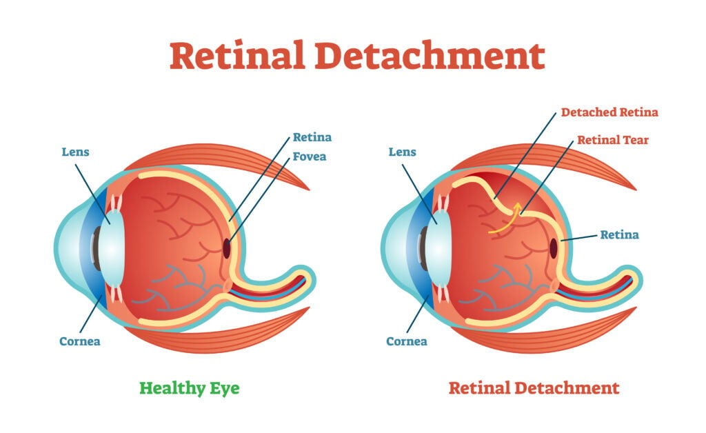 Normal Eye Retina, Illustration Stock Illustration - Illustration