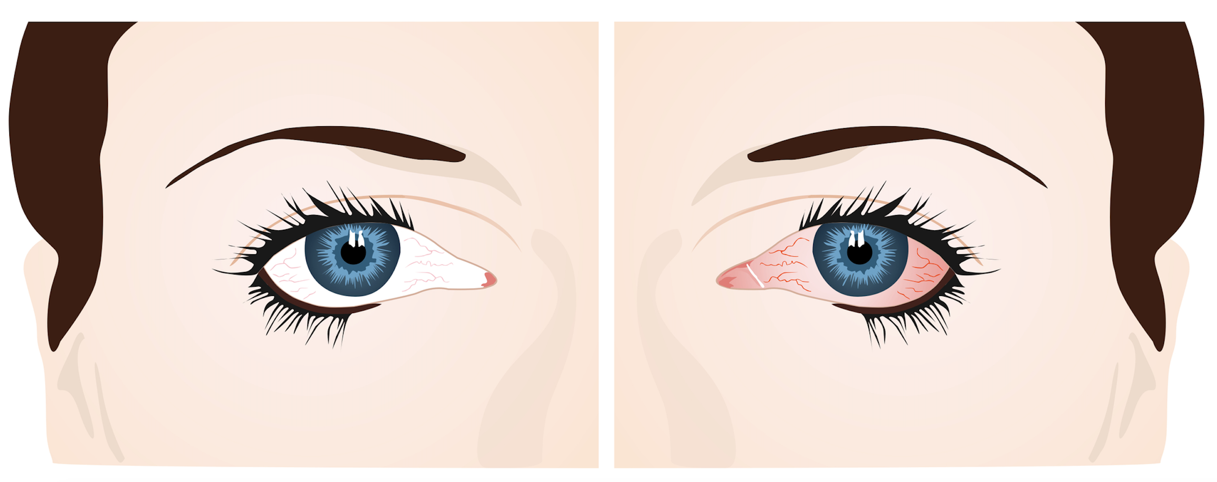 Normal eye vs burning eye