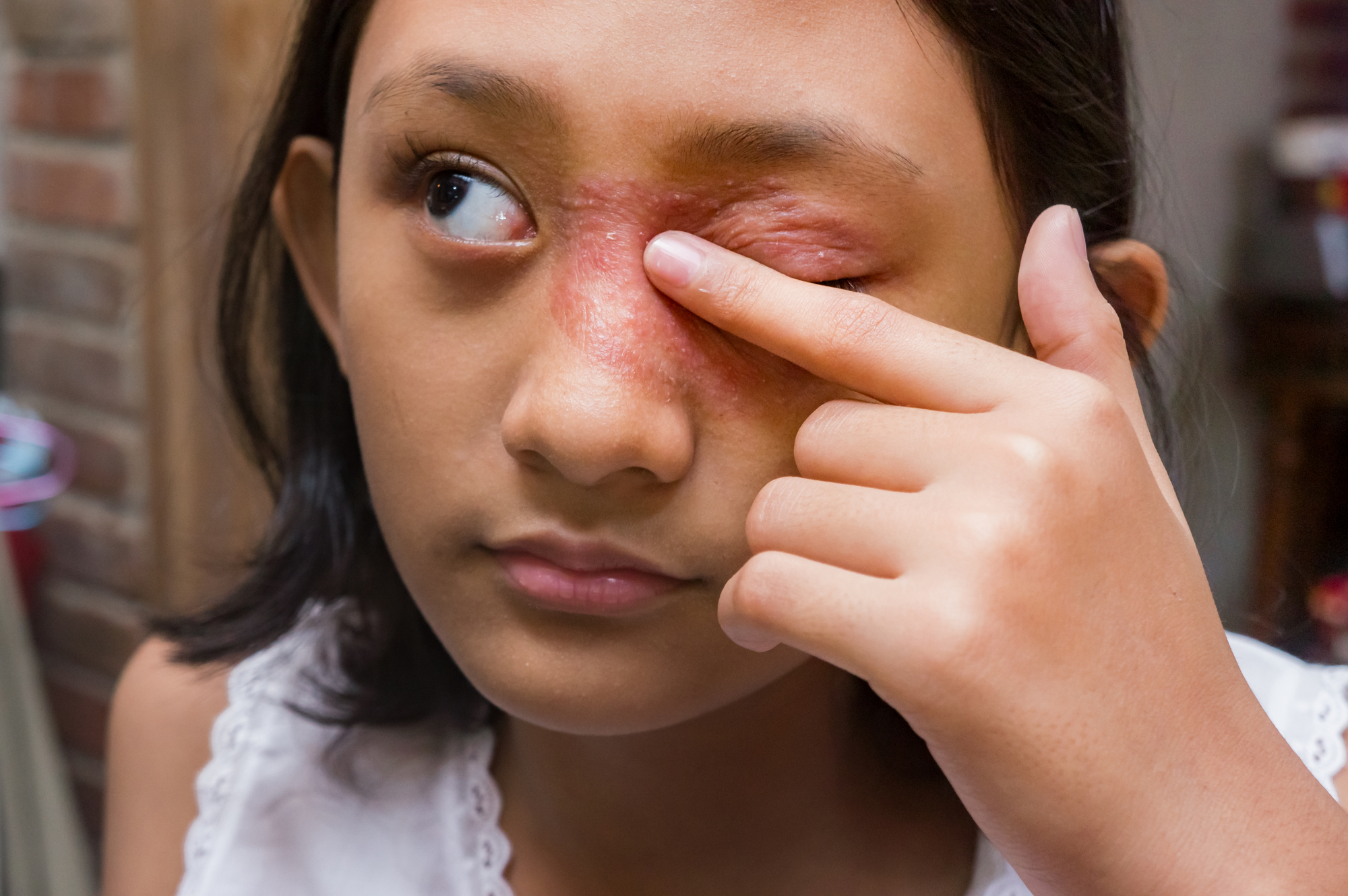 A young person with medium-length dark hair touches a red, swollen area around their left eye. They are wearing a white sleeveless top and are indoors near a brick wall.