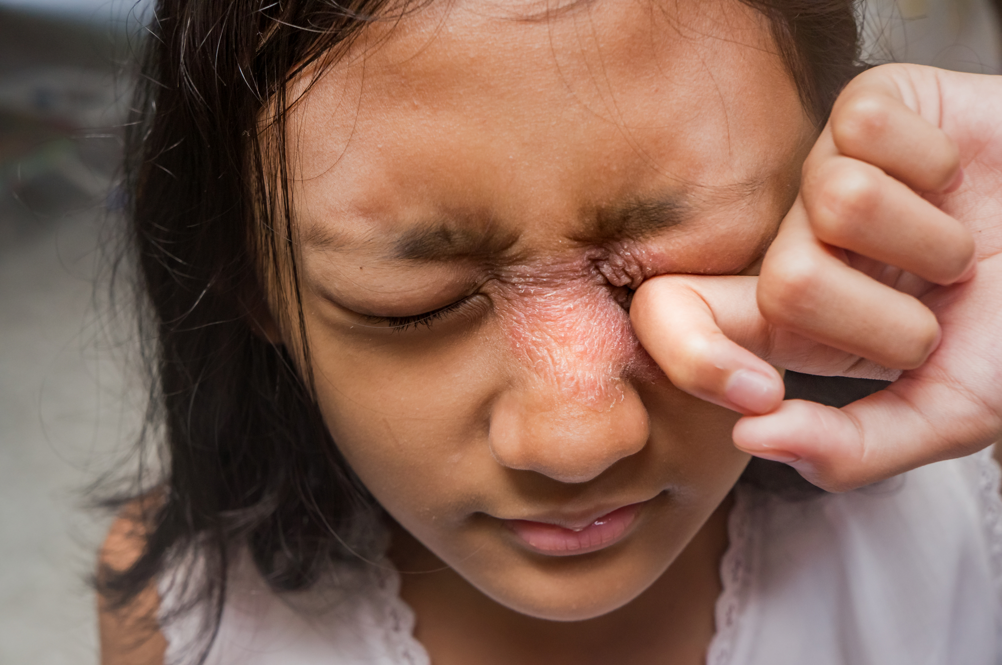 A young girl with dark hair is squeezing her eyes shut and rubbing her right eye with her hand. There is visible irritation or redness around her eye and eyebrow area. She is wearing a light-colored shirt.