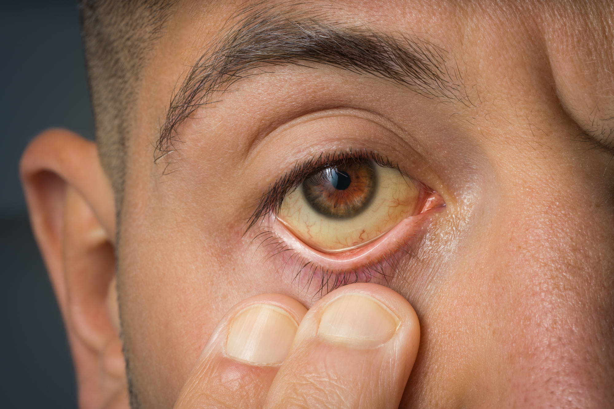 A close-up of a person's face showing a yellowish discoloration in the white of the eye. The person is using their finger to pull down the lower eyelid. The image highlights possible jaundice symptoms.