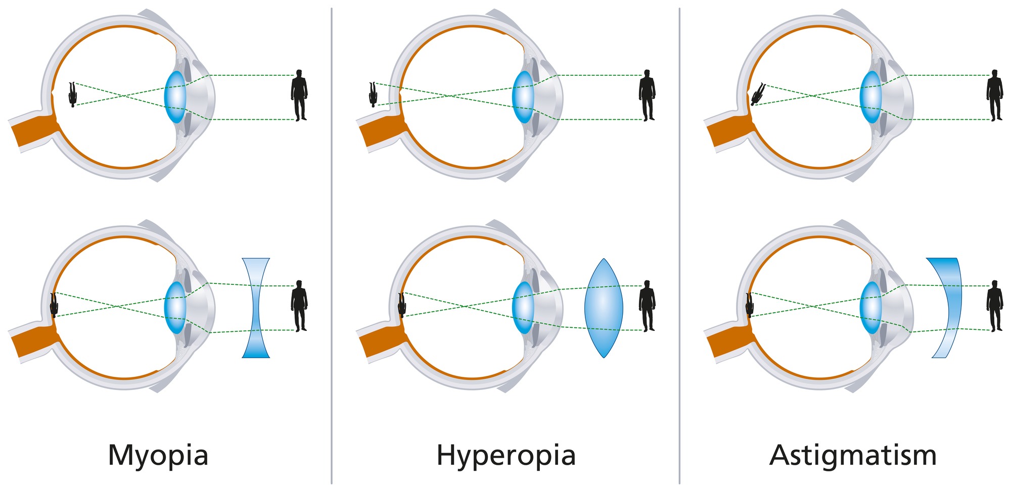 Vision defects myopia hyperopia and astigmatism illustrations