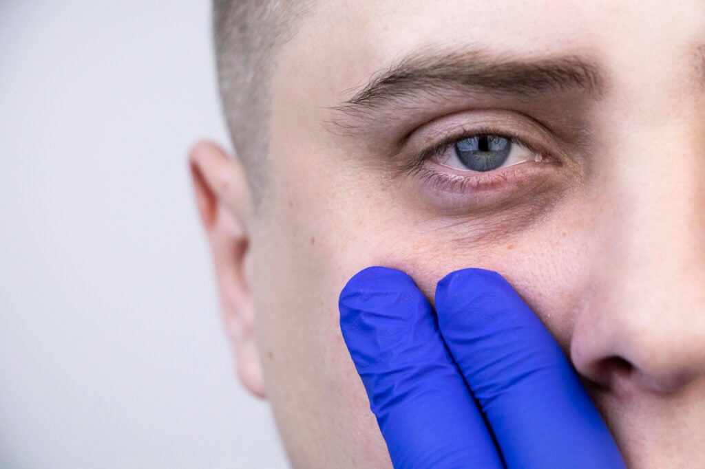 How to Treat Bags Under Your Eyes 2 class=