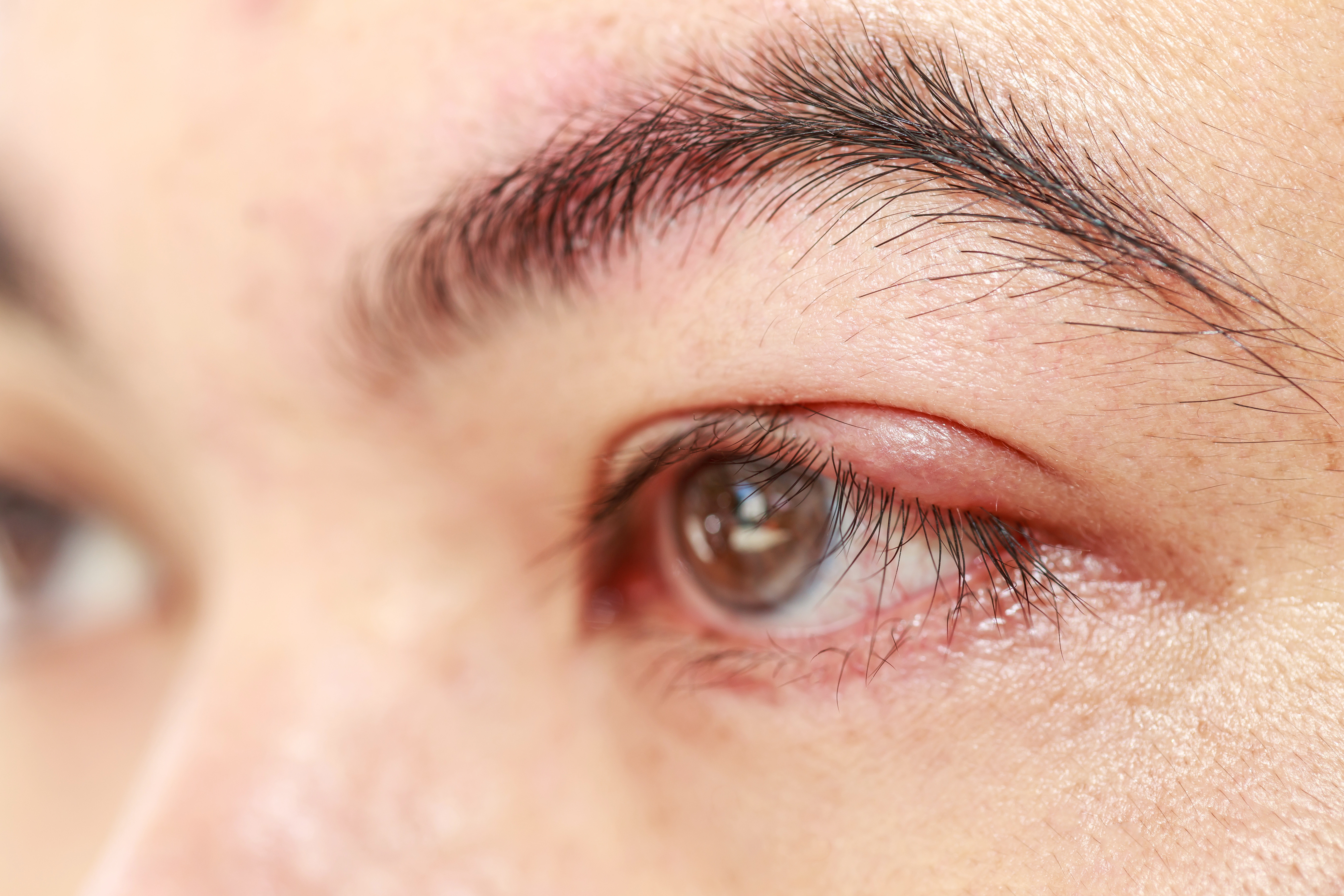 Close up shot of a woman with left upper eye lid abscess or stye or hordeolum