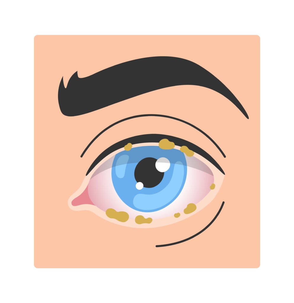 What Can Eye Discharge Mean for You? 2 class=