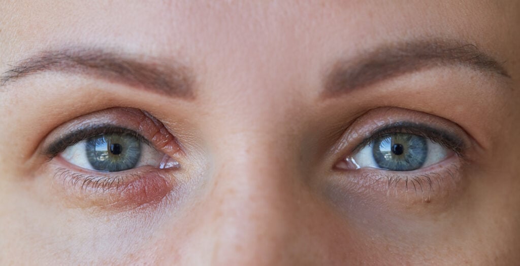 Eyelid psoriasis medical image 1