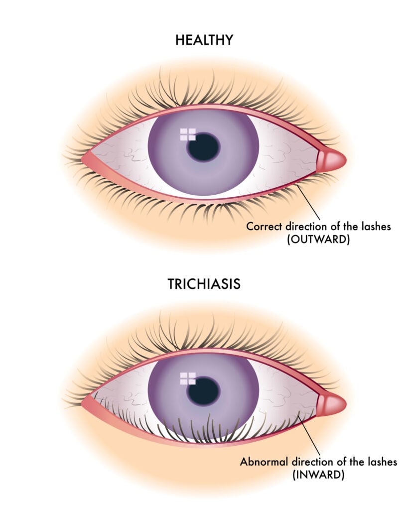 Ingrown Eyelash: Causes & How to Treat It 3 class=