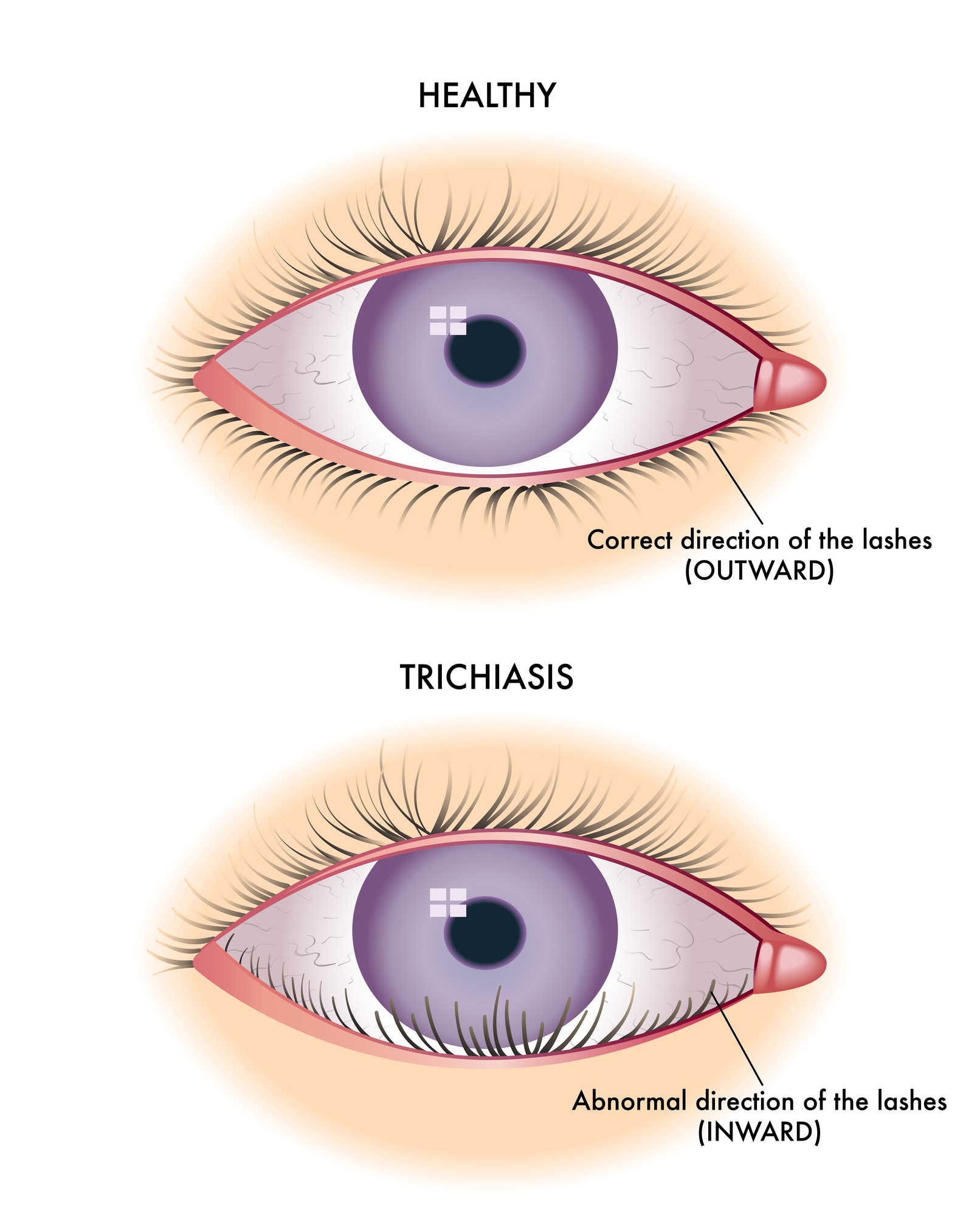 Ingrown eyelash illustration