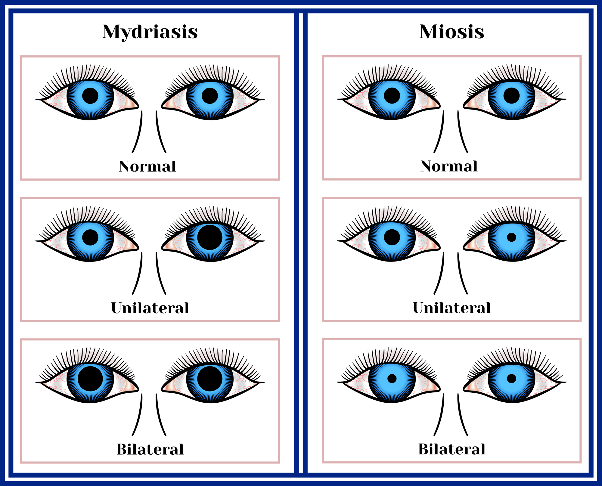 Mydriasis vs miosis