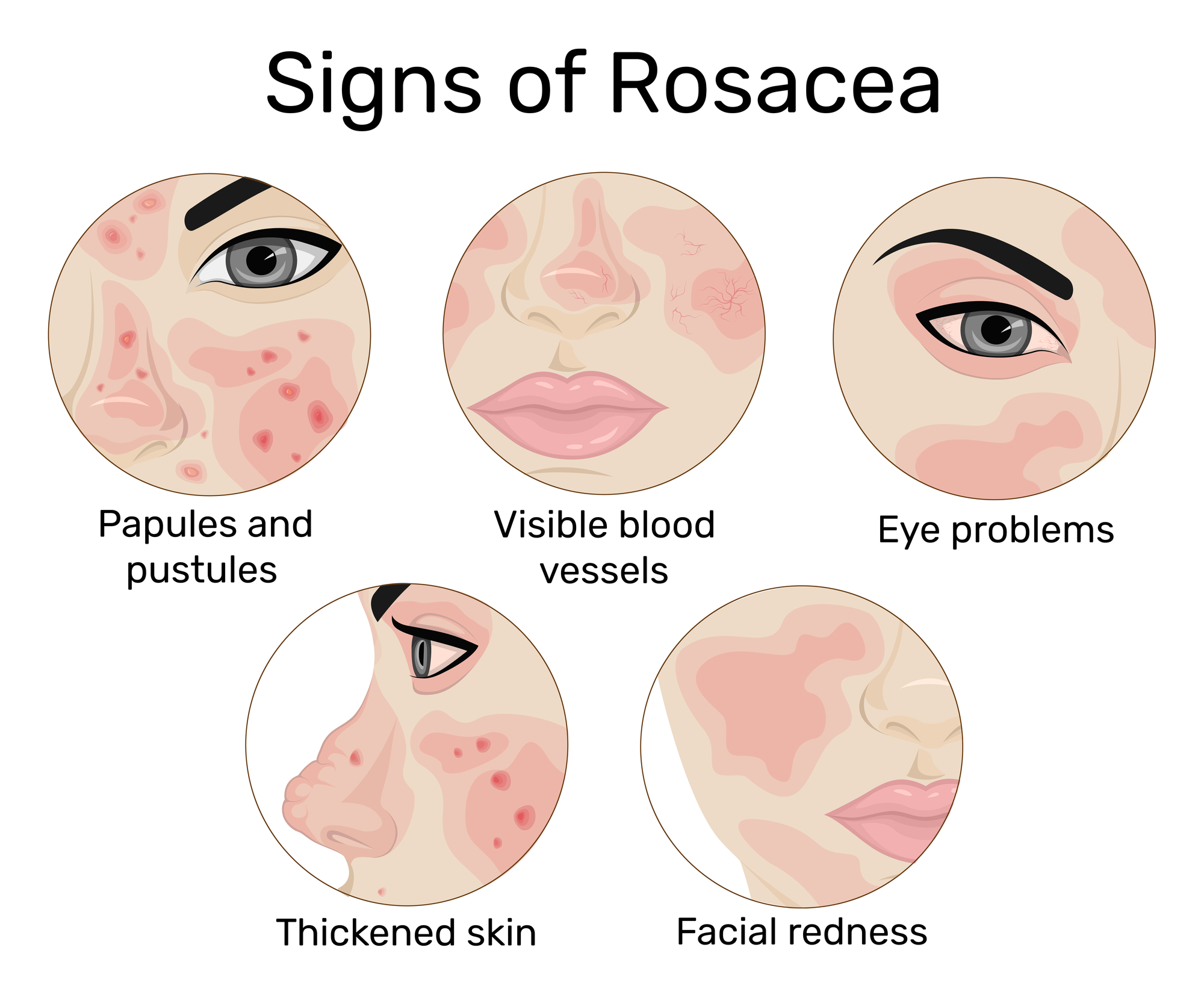 Ocular rosacea symptoms