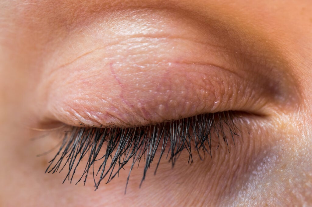 Staph Infection on the Eyelid 3 Close-up of a closed human eye with long eyelashes. The skin around the eye has a natural texture, and faint veins are visible on the eyelid. The lighting highlights the details of the eyelashes and skin.