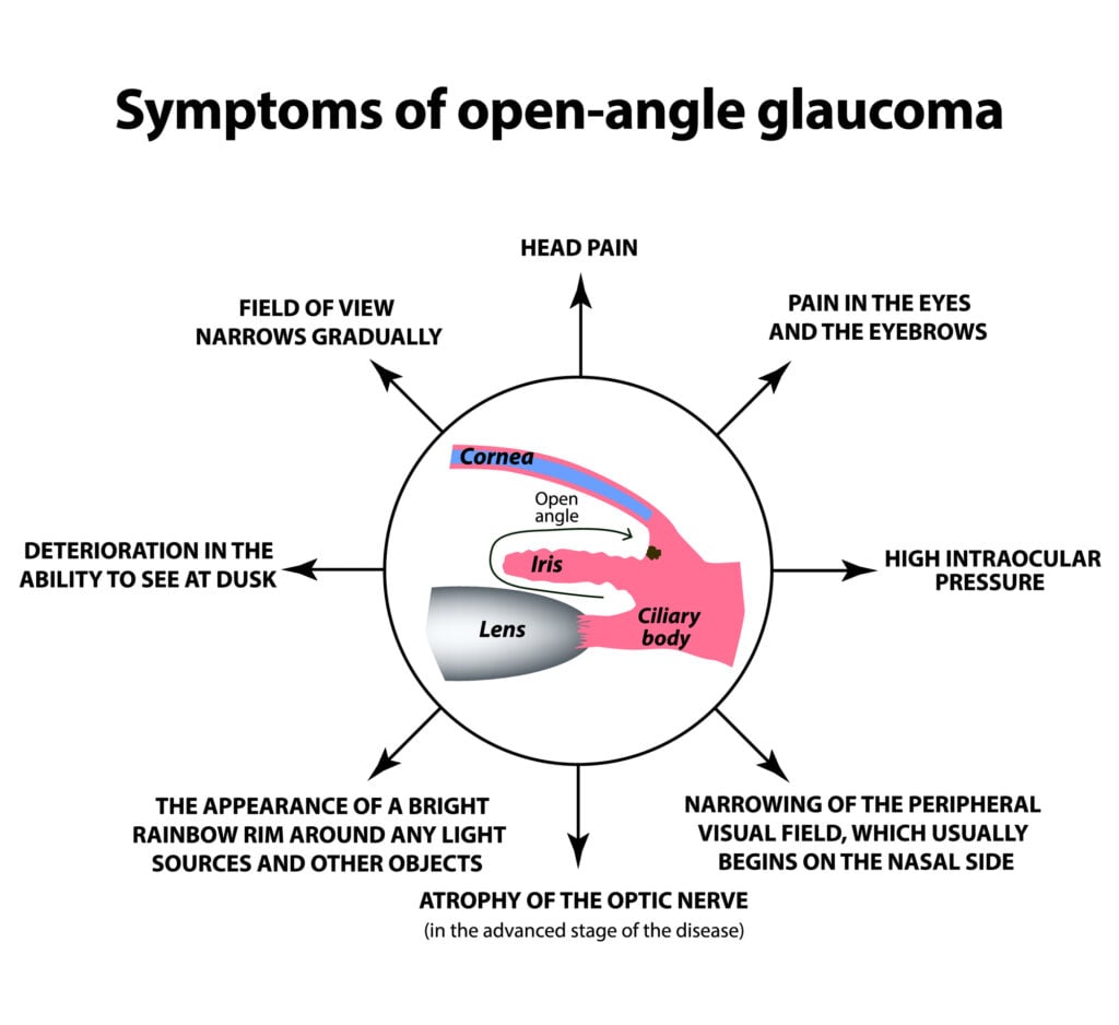 What Is Primary Open-Angle Glaucoma? 3 class=