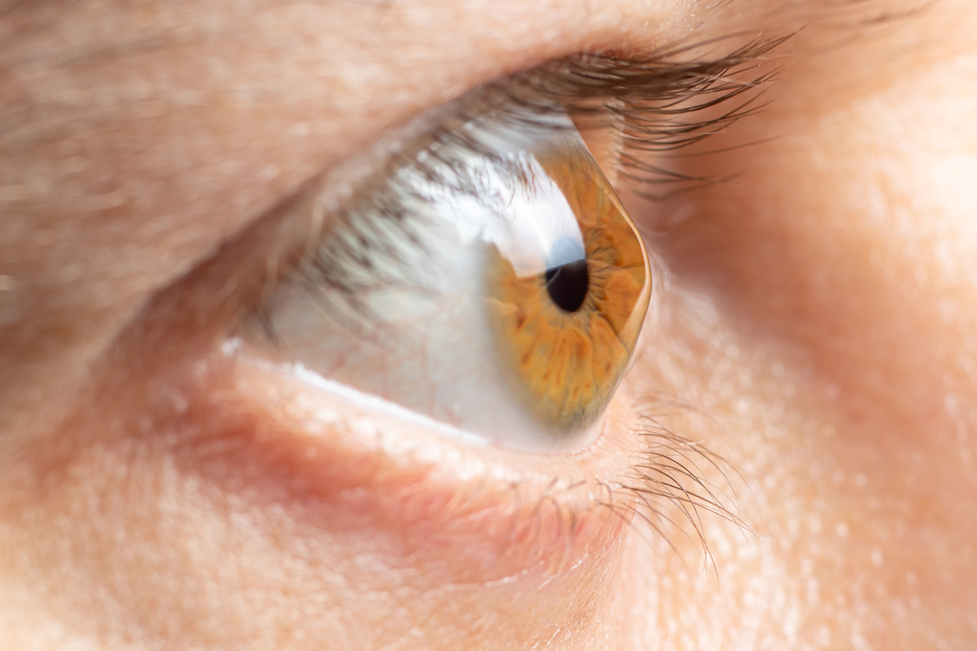 Zoomed in shot of a cornea that needs corneal cross linking procedure