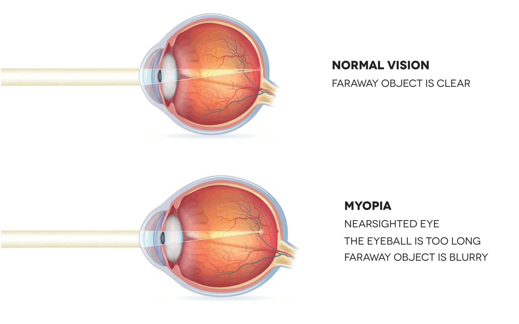 diagram comparing normal vision, myopia, and corrected myopia