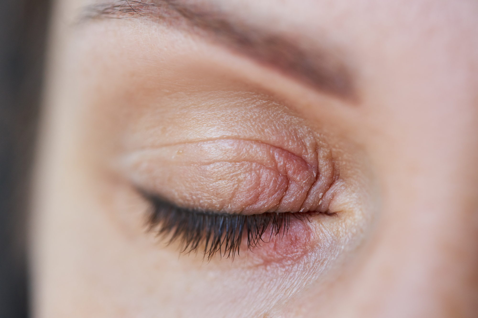 Peeling and swelling on the eyelid of the human eye due to eyelid psoriasis